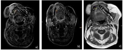 Long Term Remission and Cardiac Toxicity of a Combination of Ipilimumab and Nivolumab in a Patient With Metastatic Head and Neck Carcinoma After Progression Following Nivolumab Monotherapy